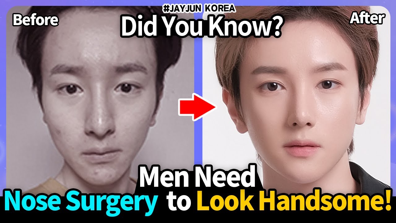 Nose Surgery! Know This Before Your First Surgery! Tips for a Successful First Nose Job!