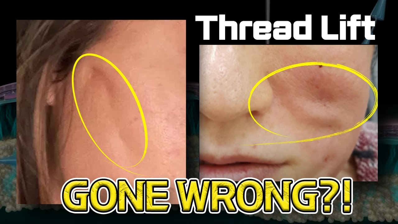 Thread Lift Gone Wrong? Watch This!