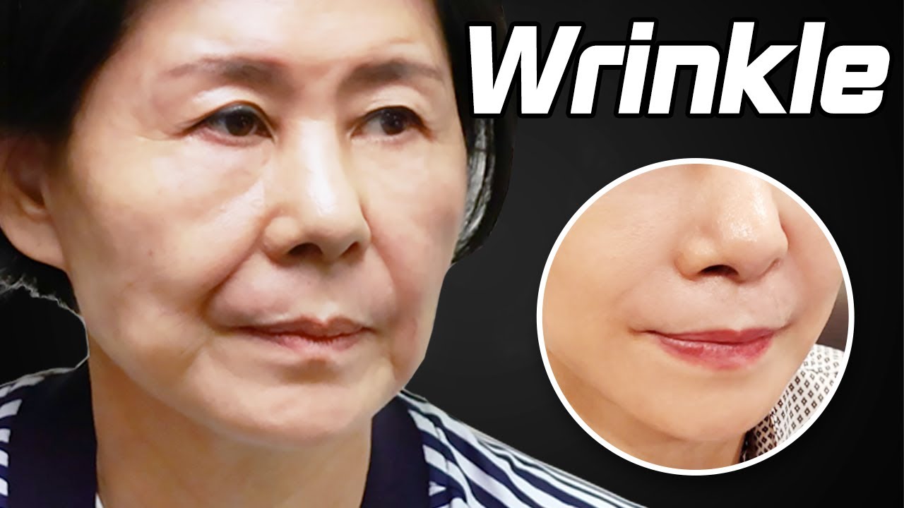 Wrinkles Suddenly on My Face!!! I Look Older Now! Why You Should Prevent Wrinkles!