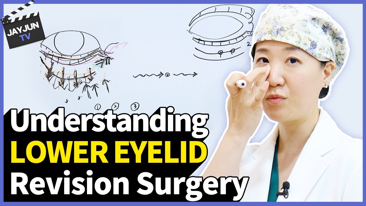Under eyes in trouble again?! Lower blepharoplasty revision surgery explained in one go!