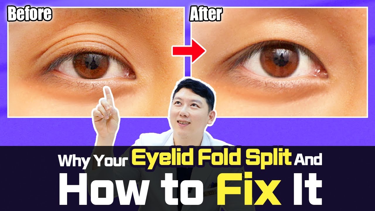 Multiple eyelid creases, why do they form and how can we fix them?