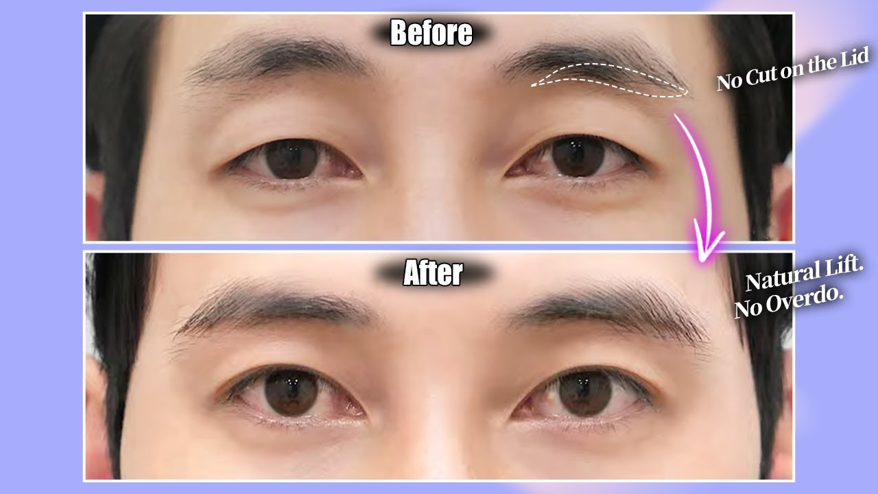 Fix Droopy Eyes Without Double Eyelid Surgery! Regain Youthful Eyes with Subbrow Lift